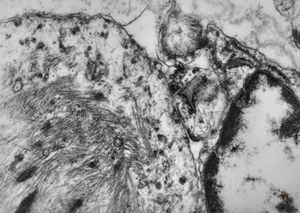 M,4m. | rhabdomyosarcoma in retented testis